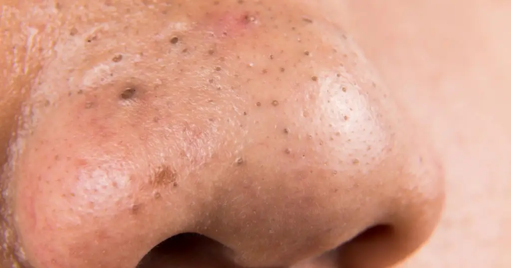 facials to remove blackheads