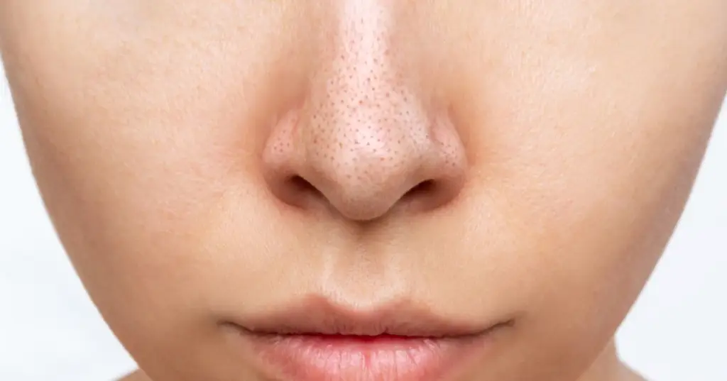 facials to remove blackheads