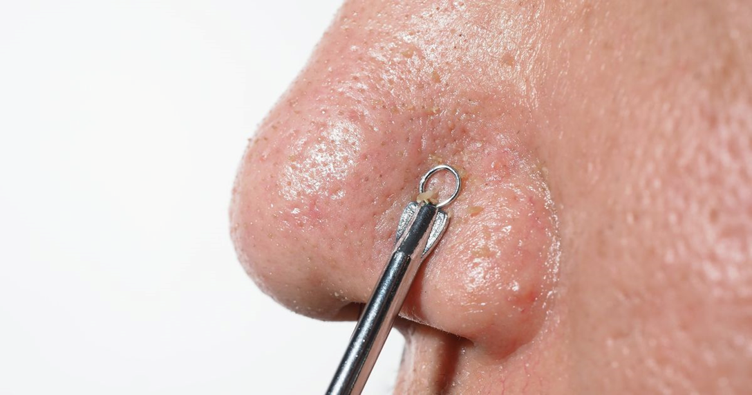 facials to remove blackheads